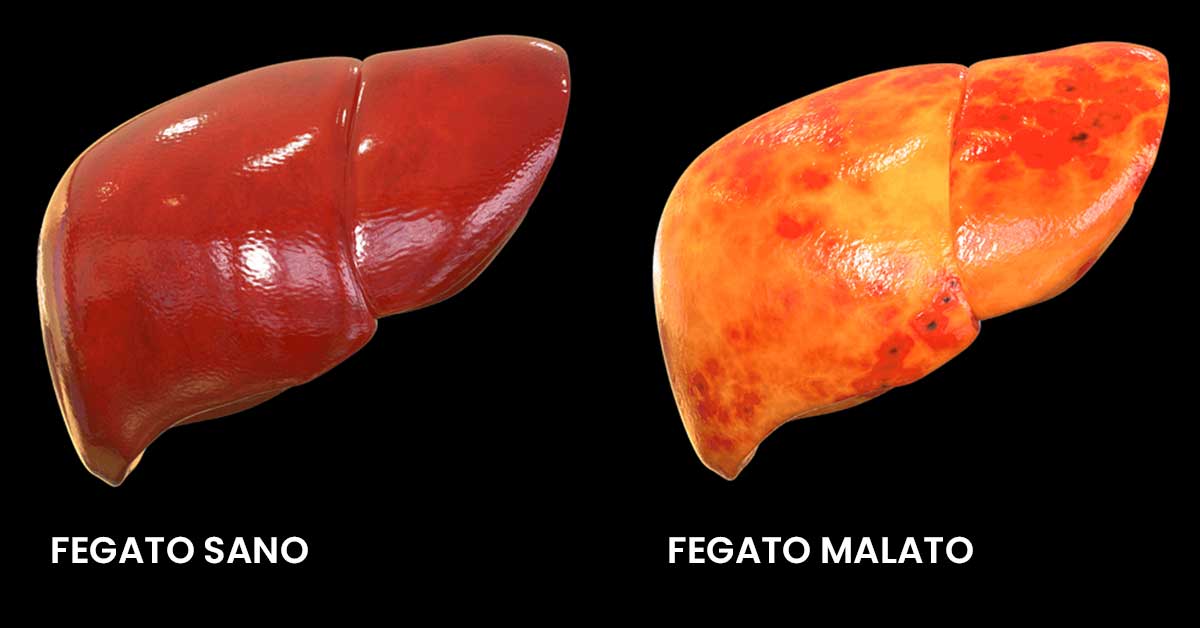 Malattie del fegato causate dall’alcol